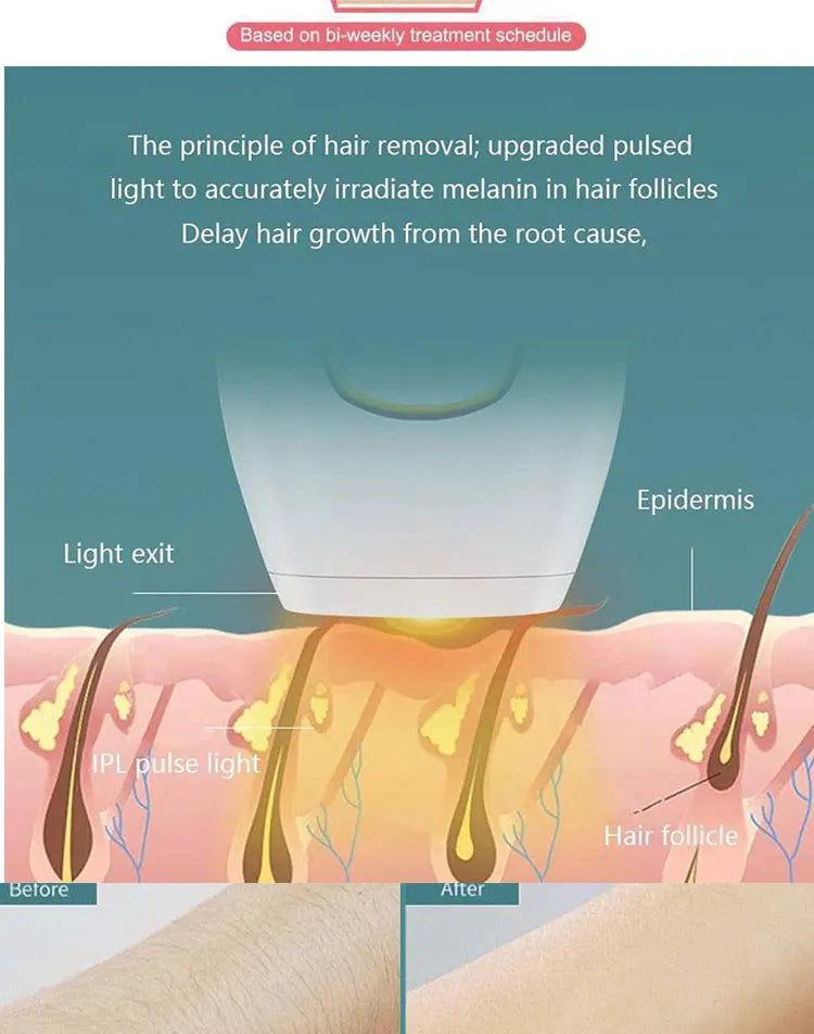 IPL Hair Removal Device – 500,000 Flashes