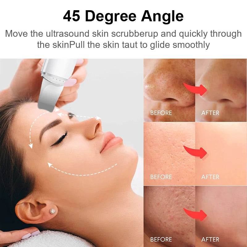 Ultrasonic Skin Scrubber & Blackhead Remover